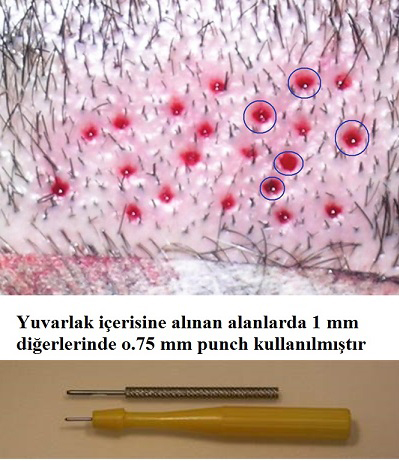 Saç Ekiminde Donör Alanın Değerlendirilmesi
