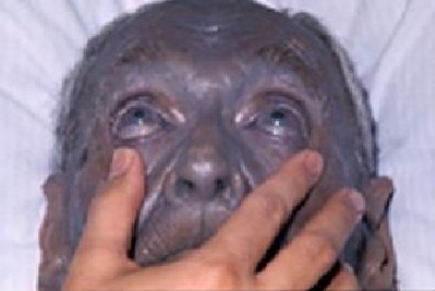 sistemik-argyria.jpg