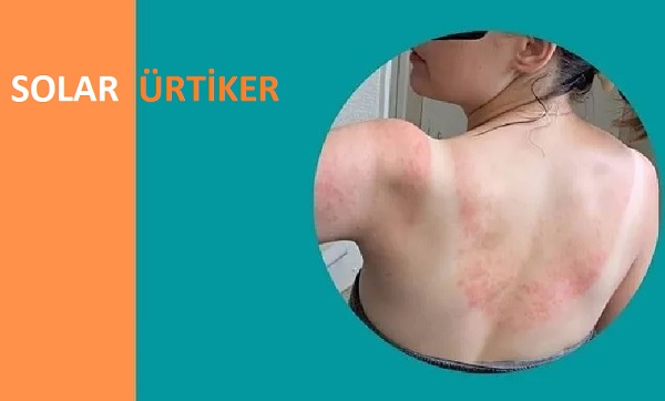 Solar Ürtiker, Güneş alerjisi