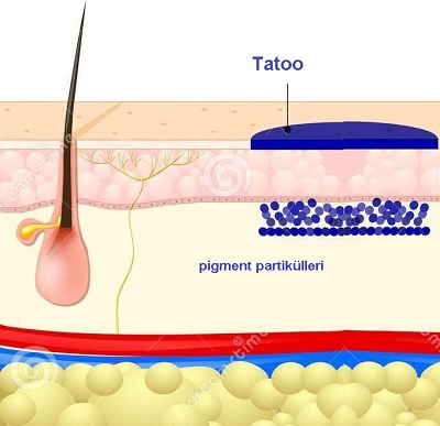 tatoo_dovme_silme_lazer_2.jpg