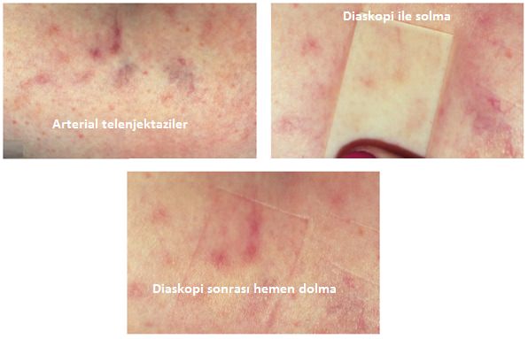telenjektazilerde-skleroterapi-01.jpg