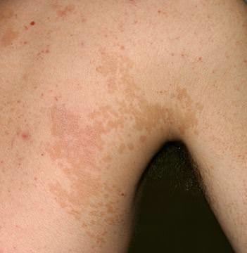 tinea-versicolor-03.jpg