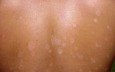 tinea-versicolor-04.jpg