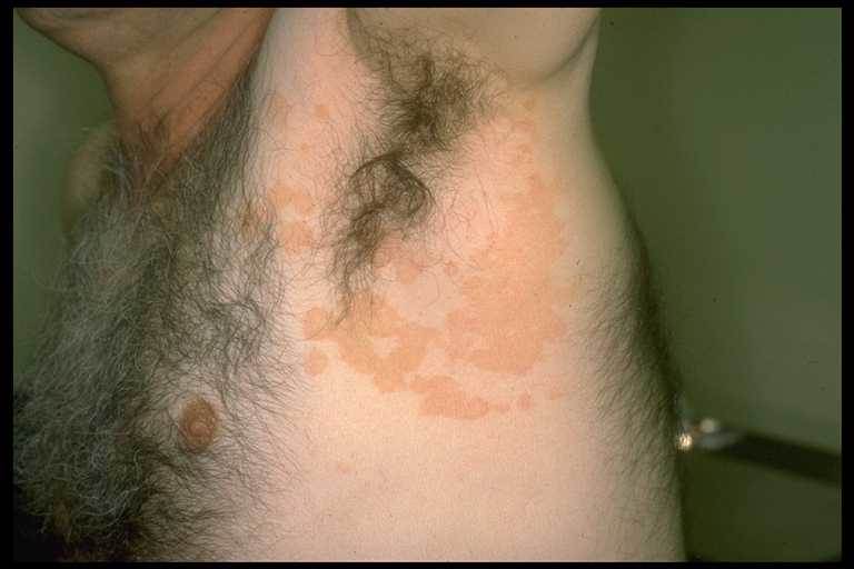 tinea-versicolor-06.jpg