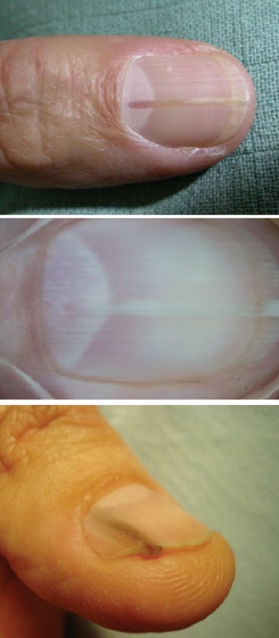 tirnak-onikopapilloma.jpg