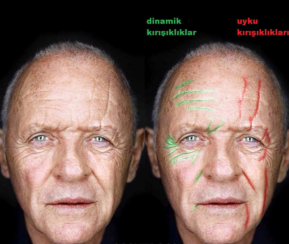 Uyku Kırışıklıkları