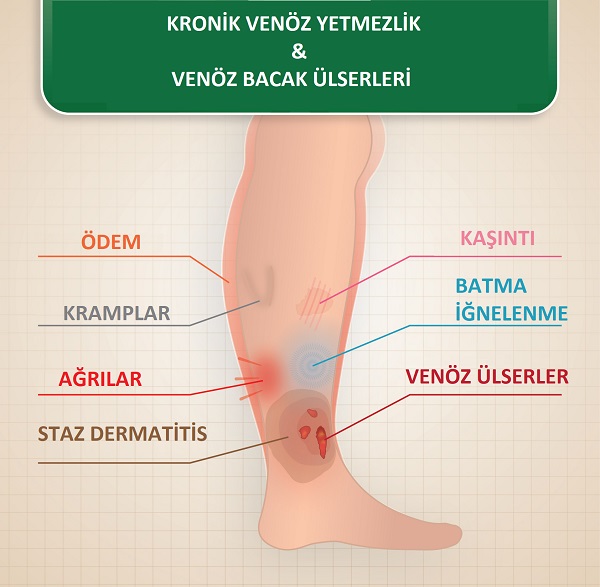 Venöz  Bacak Ülserleri, Venöz Yaralar Öneriler