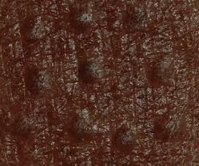 vitiligo-vitiligo-cerrahisi-mikrogreft-3.jpg