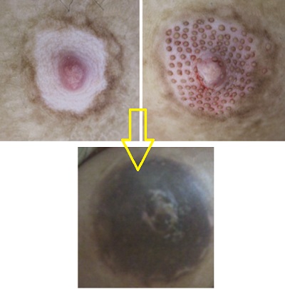 vitiligo-vitiligo-cerrahisi-mikrogreft-4.jpg