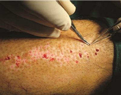 Vitiligo Mikrogreft Uygulaması, Vitiligo Cerrahisi, Melonosit Hücre Greftleri, Mikro Punch Greft