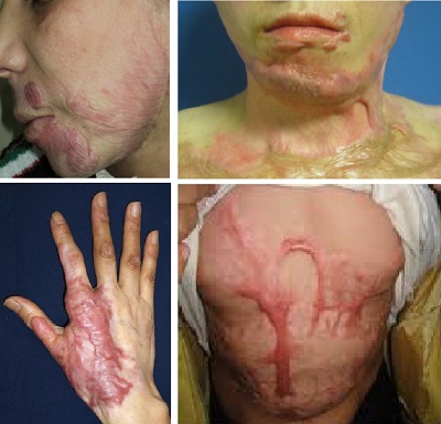 yanik-hipertrofik-skar-keloid-PDL-lazer.jpg