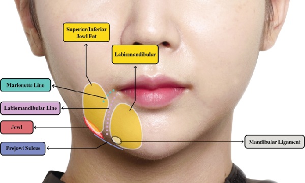 yuz_alt_dolgu_uygulamalar_labiomandibular_sulcus.jpg