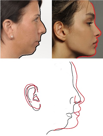 yuz_alt_kismi_estetik_anatomi_mandibula_8.jpg