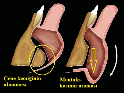mentalis 03
