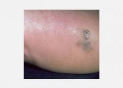 Akral Lentiginous Melanoma