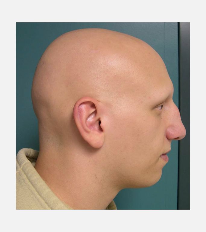 Alopecia Universalis