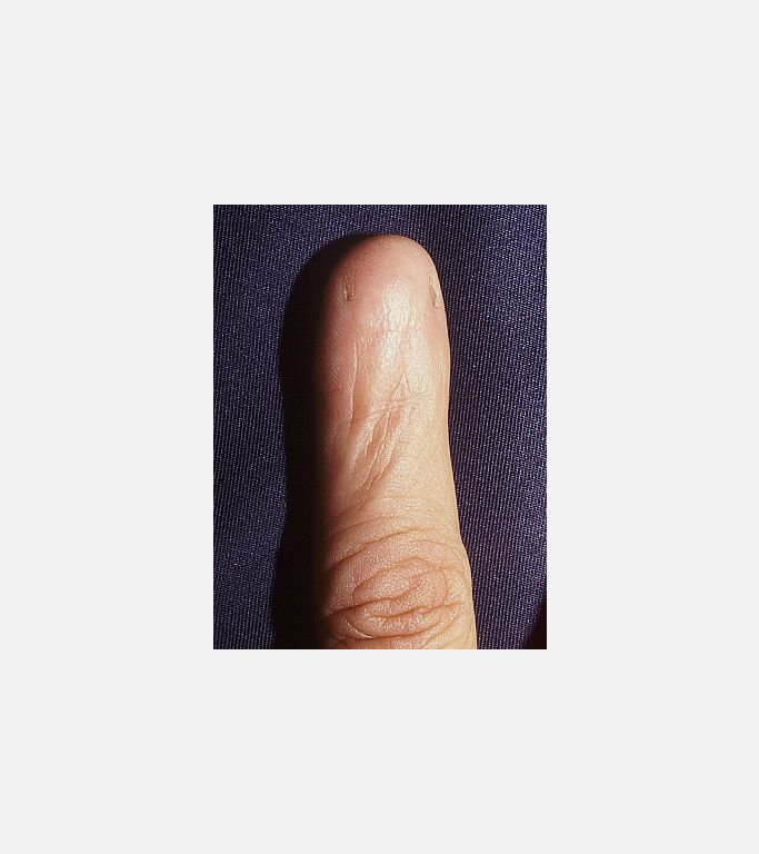 Anonychia