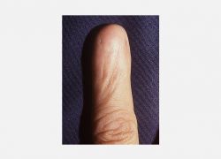 Anonychia
