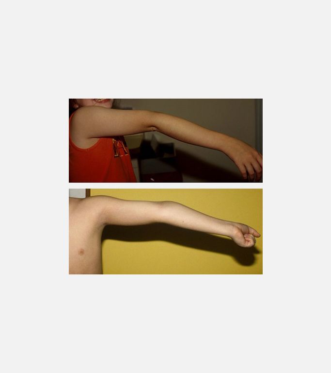 Ehler Danlos Sendromu