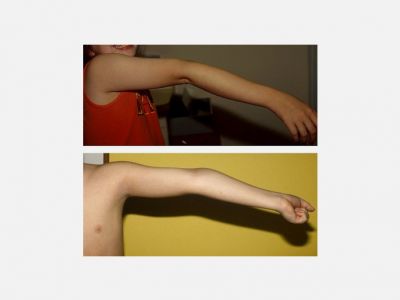 Ehler Danlos Sendromu