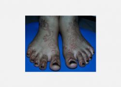 Parafenilen Diamine'in Neden Olduğu Allerjik Kontakt Dermatitis