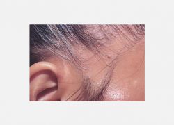 Alopecia mucinosa