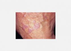 El üstünde tipik liken döküntüleri