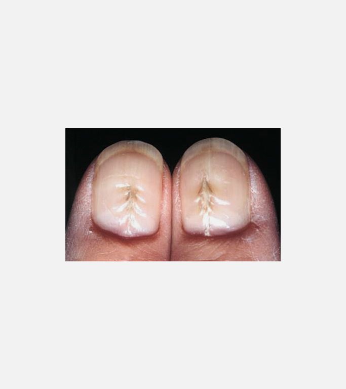 Median nail distrofi