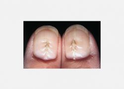 Median nail distrofi