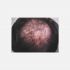 Folliculitis decalvans