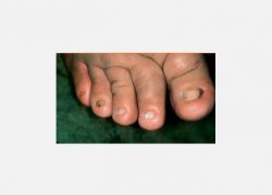 Onychoatrophy