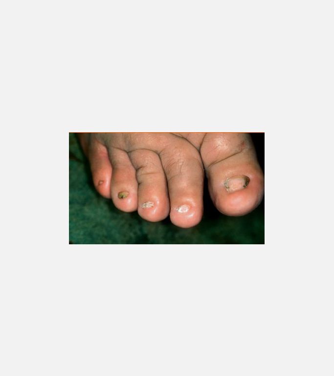 Onychoatrophy