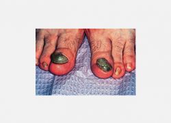 Onychogryphosis