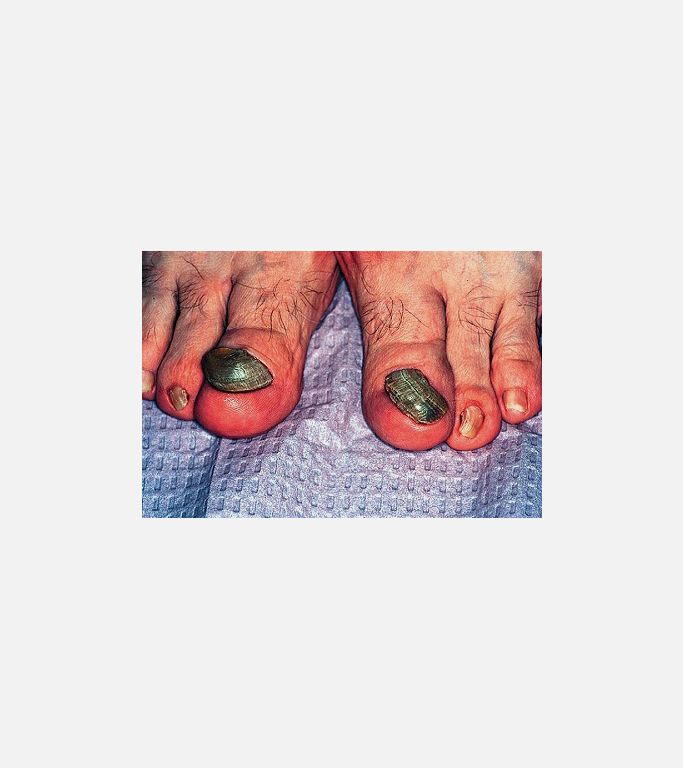 Onychogryphosis