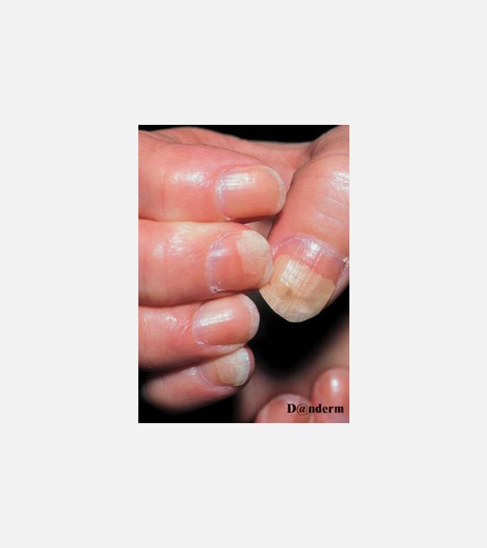 Onycholysis, onikolizis