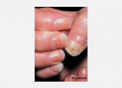 Onycholysis, onikolizis