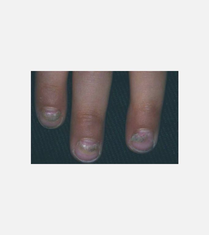 Onychomadesis