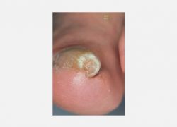 Pincer nail, kerpeten tırnak