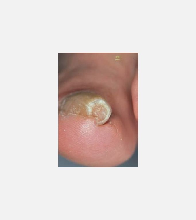 Pincer nail, kerpeten tırnak