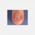 Pterygium deformitesi