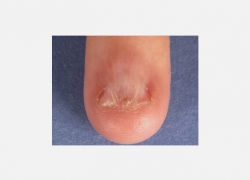 Pterygium deformitesi