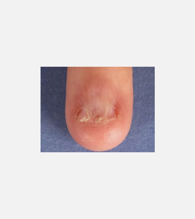 Pterygium deformitesi