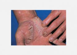 Palmoplantar Psoriais
