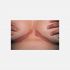 Flexural veya invers psoriasis(Ters Yerleşimli Sedef)