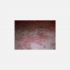 Püstüler psoriasis