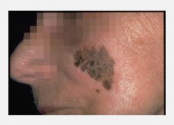 Yüzeysel Yayılan Melanoma